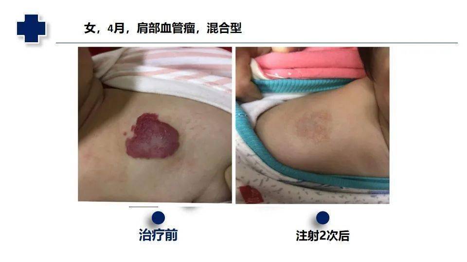 锌硒宝治疗病（锌硒宝有效果吗）-硒宝网