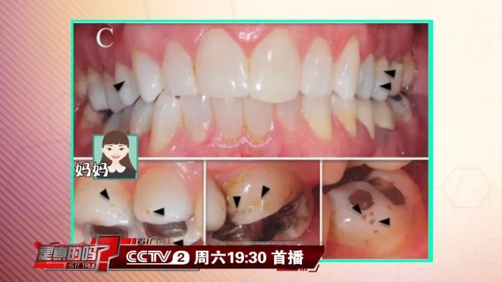 补钙能坚固牙齿吗(坚固牙齿吃什么钙片好)-硒宝网