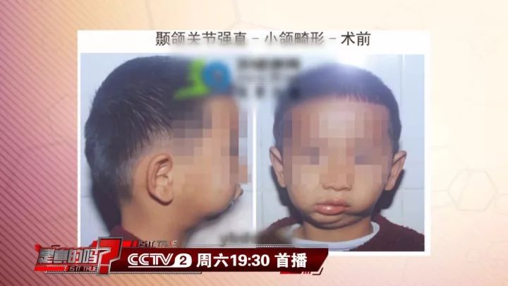 补钙能坚固牙齿吗(坚固牙齿吃什么钙片好)-硒宝网