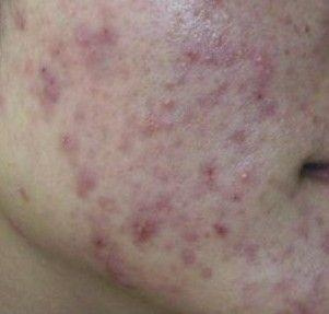 锌硒宝治痤疮(锌痤疮)-硒宝网