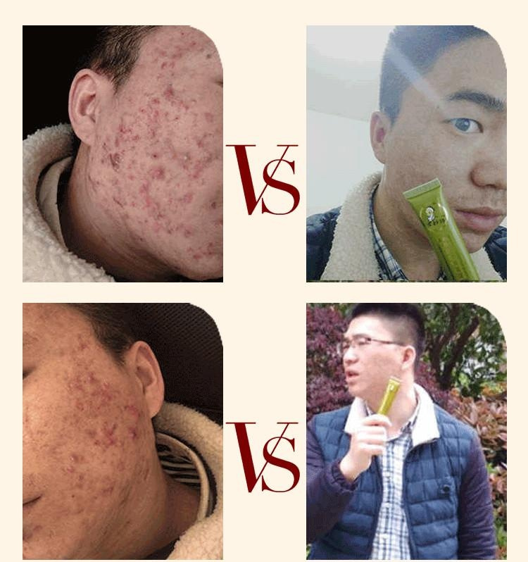 锌硒宝治痤疮(锌痤疮)-硒宝网