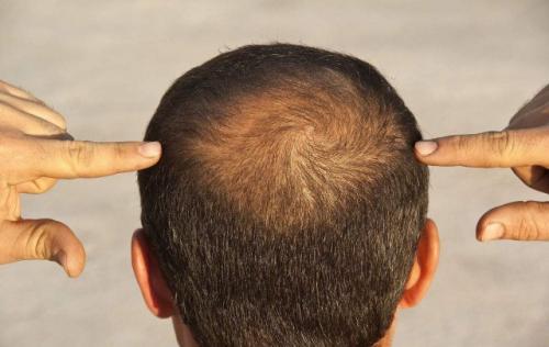 吃锌硒宝脱发(脱发补硒和锌)-硒宝网