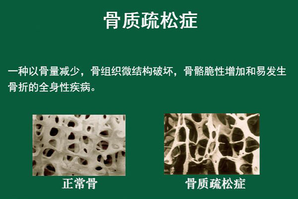 成人如何补钙(成人补钙什么牌子钙片效果最好)-硒宝网