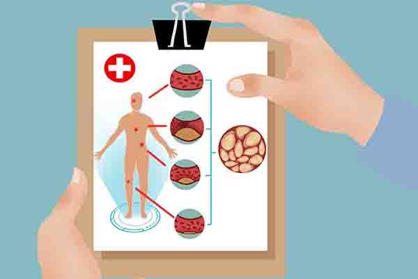 锌硒宝对肌酐（锌硒宝有什么副作用吗）-硒宝网