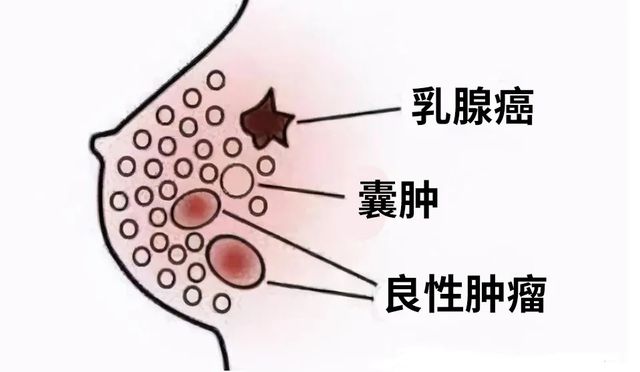 乳腺癌 硒维康(硒对乳腺癌的作用)-硒宝网