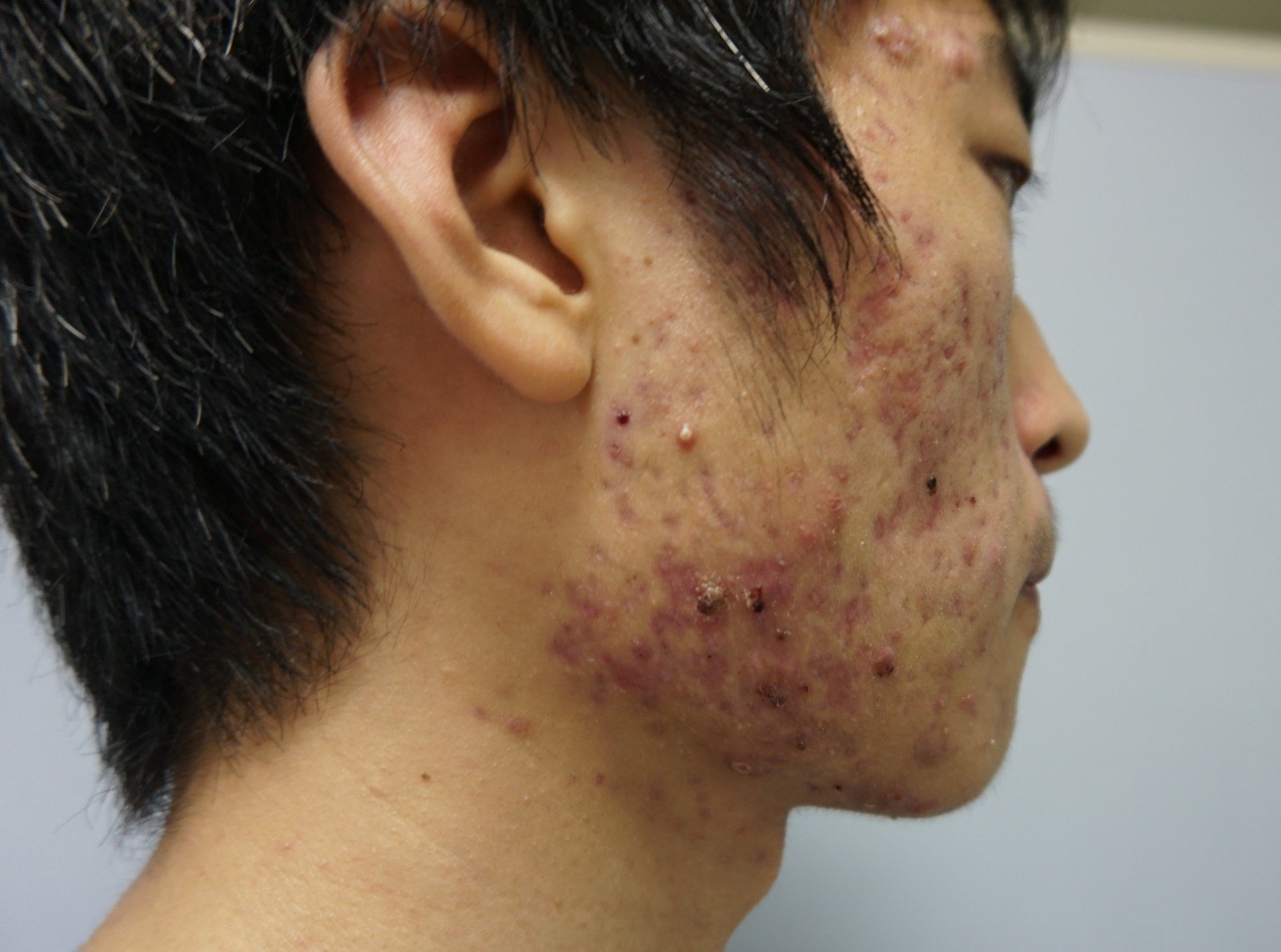 补硒治皮脂囊肿（皮脂治补囊肿硒有用吗）-硒宝网