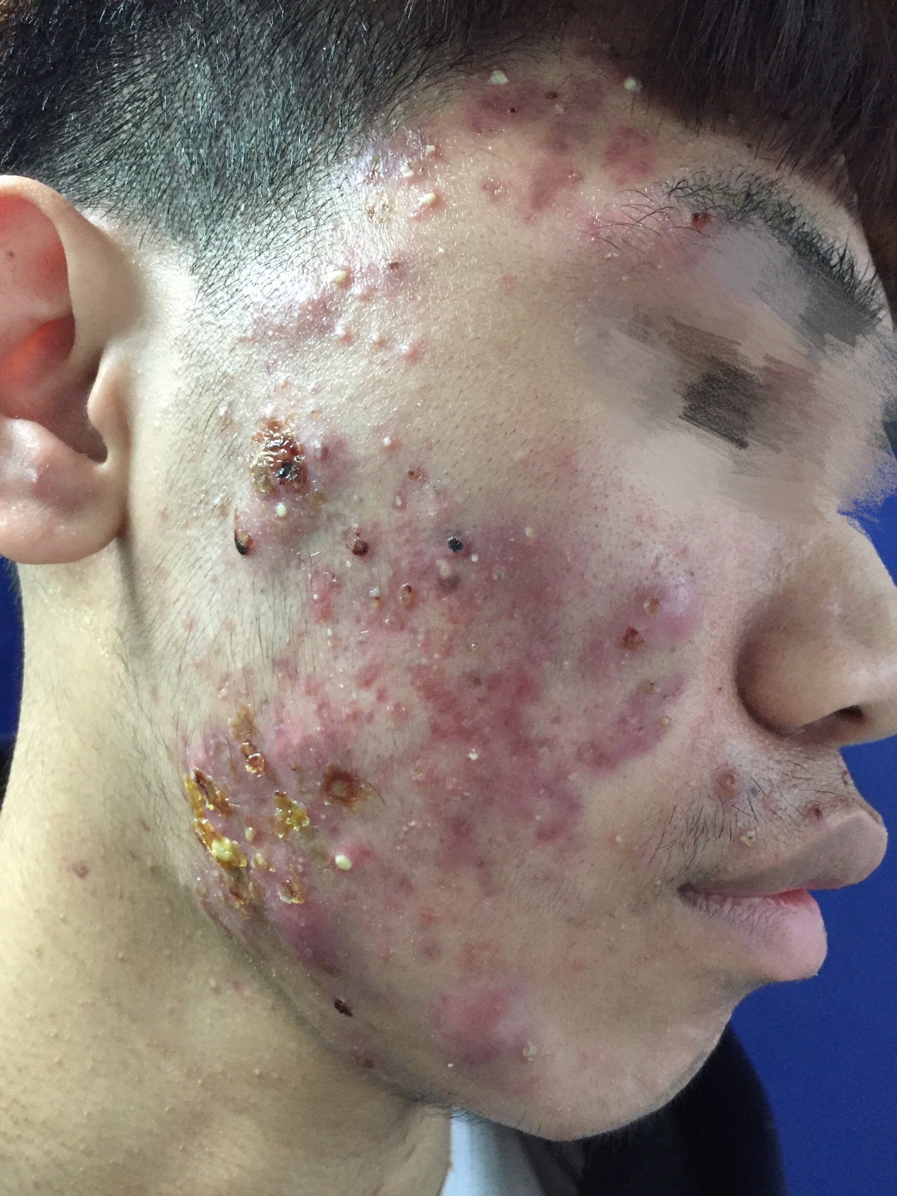 补硒治皮脂囊肿（皮脂治补囊肿硒有用吗）-硒宝网