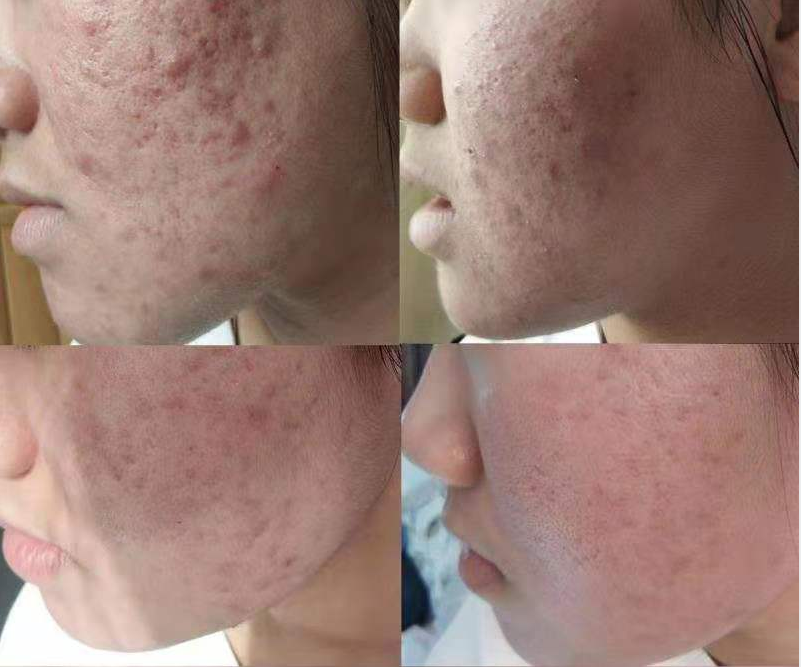 补硒治皮脂囊肿（皮脂治补囊肿硒有用吗）-硒宝网