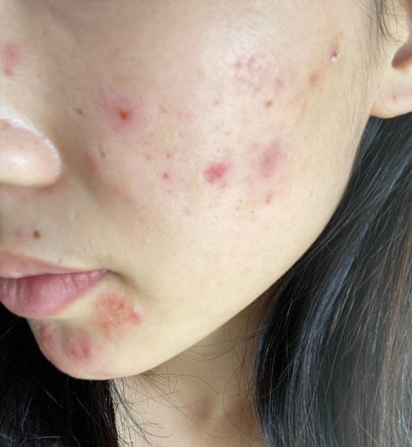 补硒治皮脂囊肿（皮脂治补囊肿硒有用吗）-硒宝网