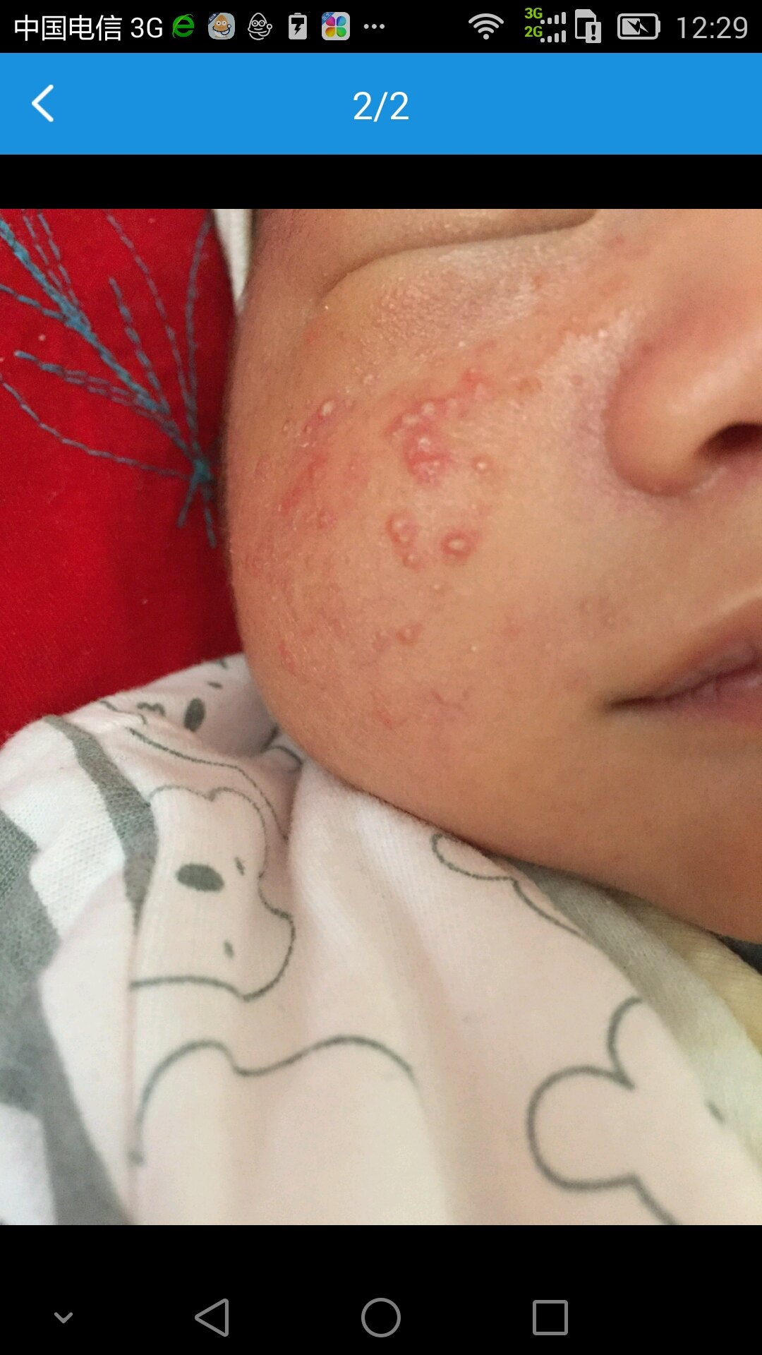 补硒治皮脂囊肿（皮脂囊肿外用药）-硒宝网