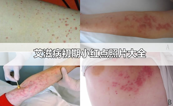 补硒预防艾滋病（hiv补硒）-硒宝网