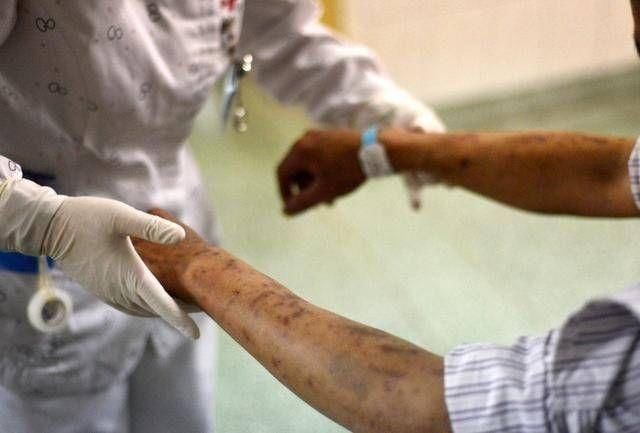 补硒预防艾滋?。╤iv补硒）-硒宝网