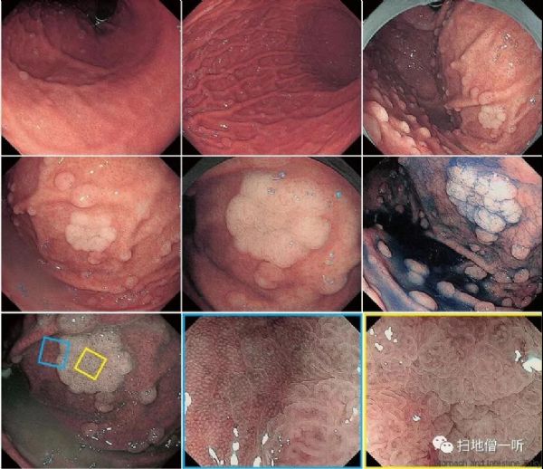 胃癌晚期 补硒（晚期补胃癌硒有用吗）-硒宝网