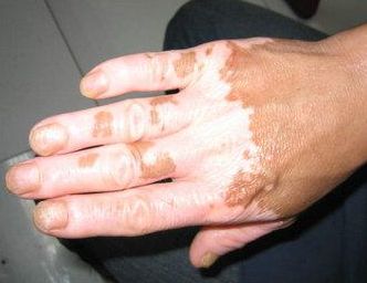 白癜风补硒药物（治疗老年的白癜风的药物）-硒宝网