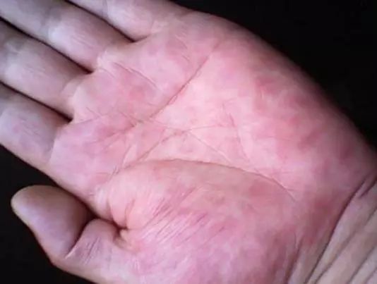 肝癌晚期 补硒（晚期补肝癌硒的作用）-硒宝网