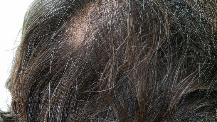 补铁可以防止掉头发吗(掉头发防止补铁可以长头发吗)-硒宝网