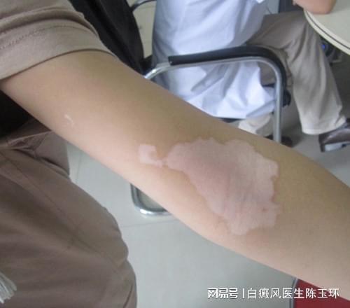 白癜风如何补硒（怎样科学补硒）-硒宝网