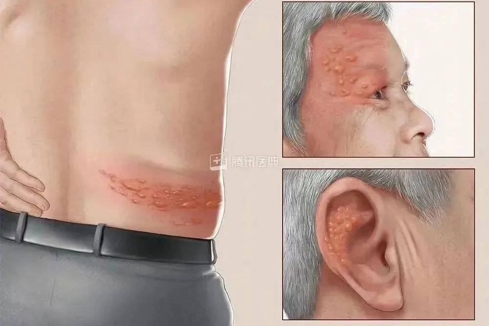 高危hpv补硒（hpv高危补硒有用吗）-硒宝网