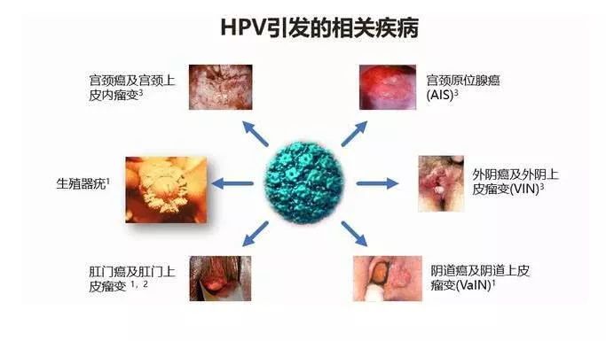 补硒防止hpv（补硒能去除hpv病毒吗）-硒宝网