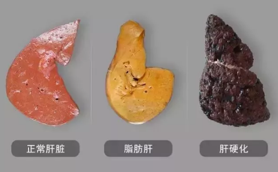 乙肝需要 补硒（乙肝补硒有什么副作用）-硒宝网