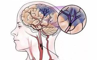 补硒 心脑血管(补硒对心脑血管的作用)-硒宝网