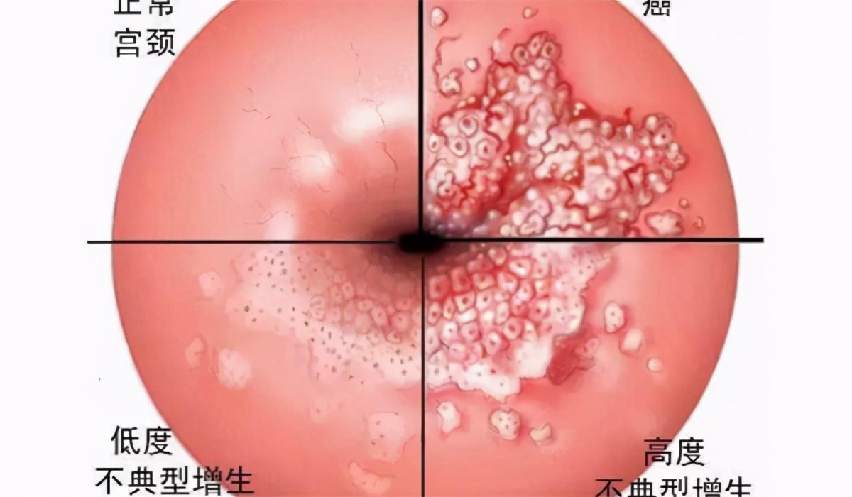 补硒对宫颈好吗(补硒对宫颈炎有好处吗)-硒宝网