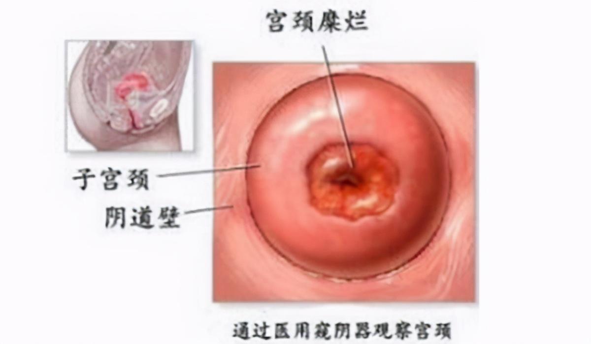 补硒对宫颈好吗(补硒对宫颈炎有好处吗)-硒宝网
