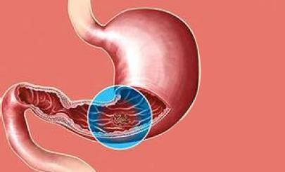 补硒能治疗肠胃(肠胃不好吃硒管用吗)-硒宝网