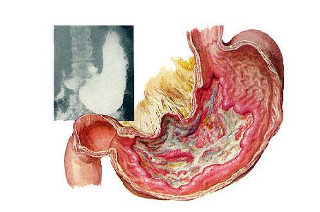 补硒能治疗肠胃(肠胃不好吃硒管用吗)-硒宝网