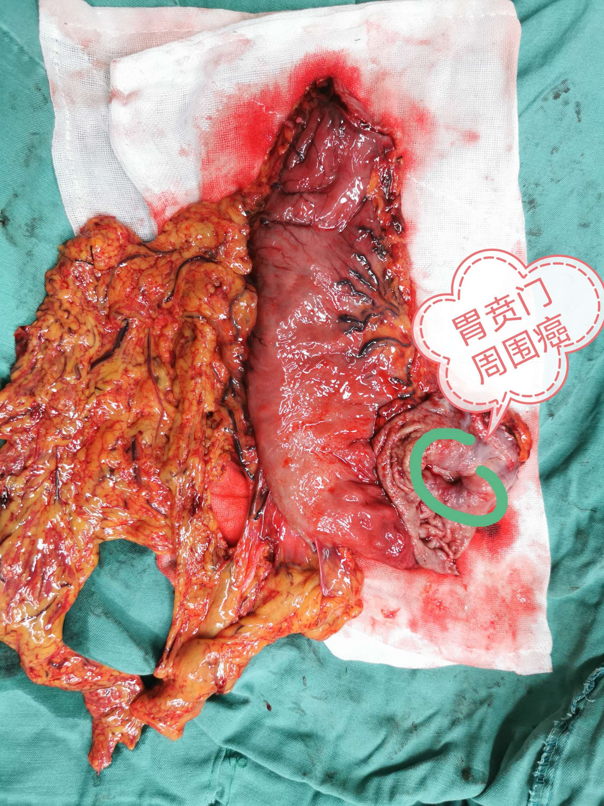 胃癌后怎么补硒（胃癌补硒有好处吗）-硒宝网