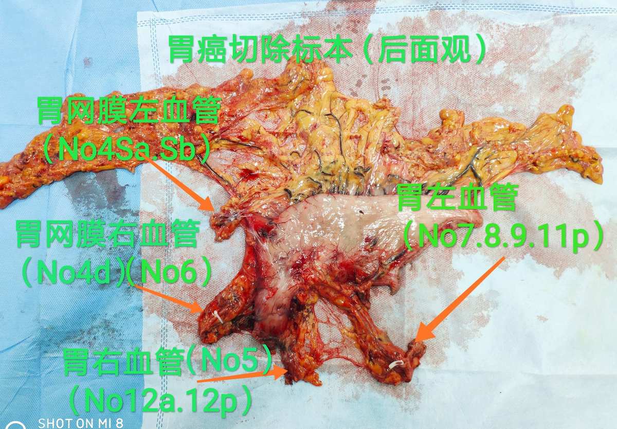 胃癌后怎么补硒（胃癌补硒有好处吗）-硒宝网