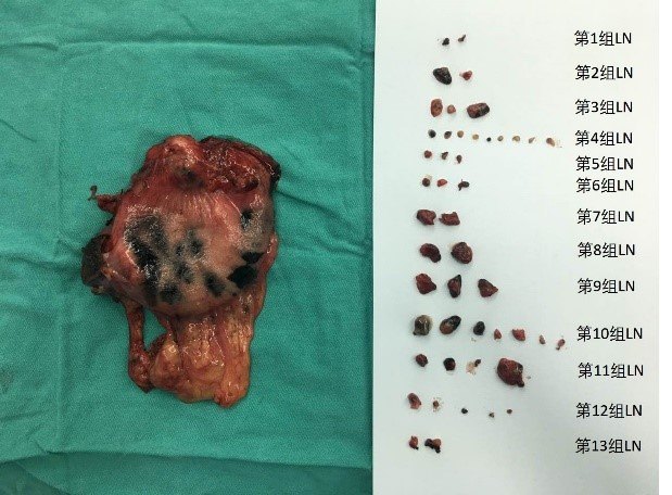 胃癌后怎么补硒（胃癌补硒有好处吗）-硒宝网