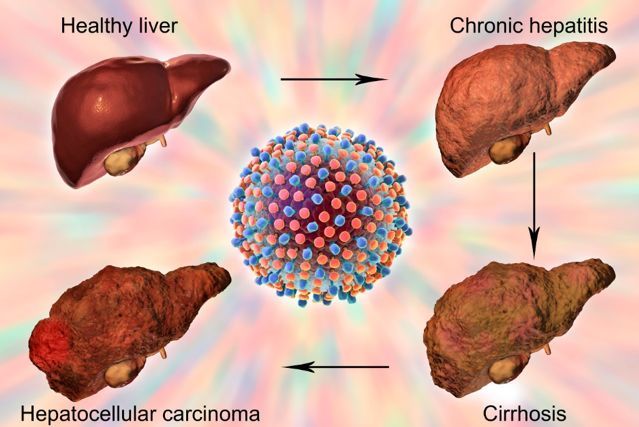 肝炎人怎样补硒(肝病患者补硒)-硒宝网
