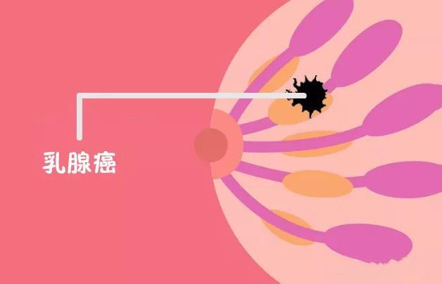 补硒与乳腺增生（乳腺增生吃硒有效果吗）-硒宝网