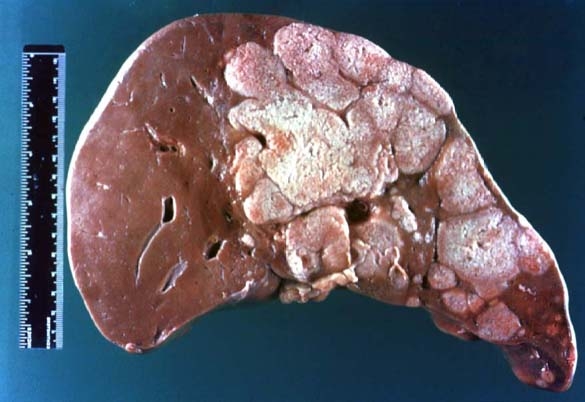 补硒的身体反应(补了硒这些反应是正常的)-硒宝网