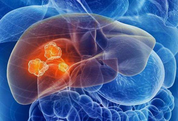 哪些癌症要补硒(癌症患者补硒吃什么药)-硒宝网