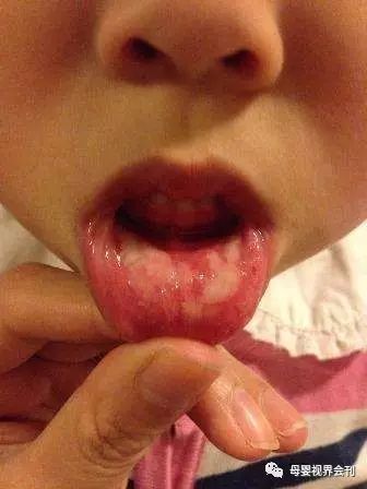 补锌补多了会怎么样(补锌会超标吗)-硒宝网