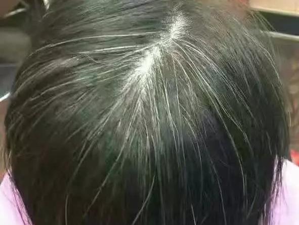 白头发是缺少什么微量元素(少白头不缺微量元素)-硒宝网