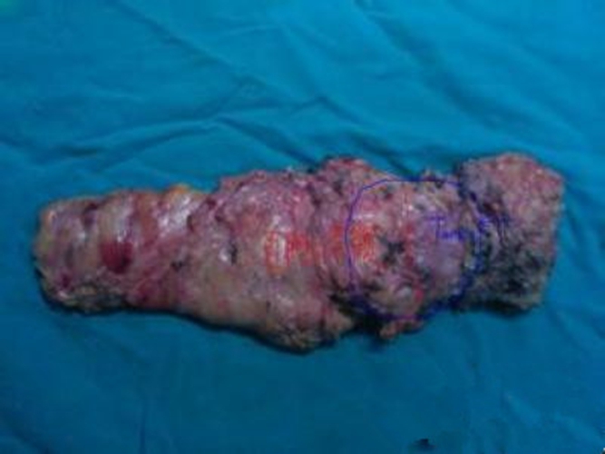 肠道息肉补硒吗（肠息肉吃硒酵母好吗）-硒宝网