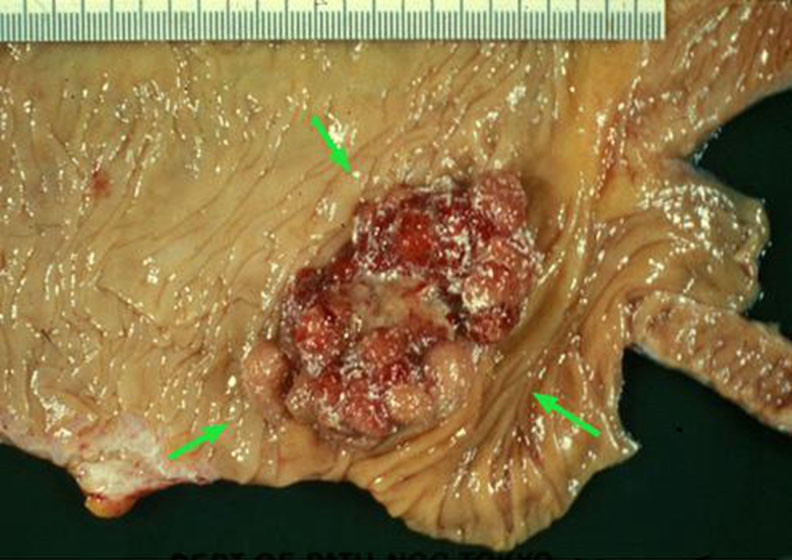 肠道息肉补硒吗（肠息肉吃硒酵母好吗）-硒宝网