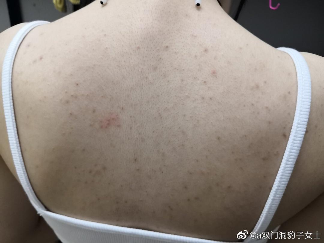 补锌可以祛痘吗(祛痘补锌可以补多久)-硒宝网