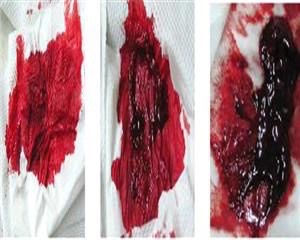 肠道息肉补硒吗(肠道补息肉硒片有用吗)-硒宝网