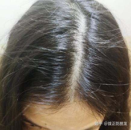 补铁可以防止掉头发吗(掉头发防止补铁可以吃什么)-硒宝网