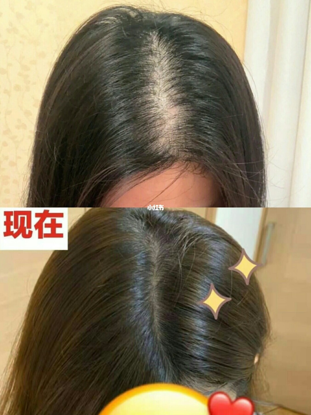 补铁可以防止掉头发吗(掉头发防止补铁可以吃什么)-硒宝网