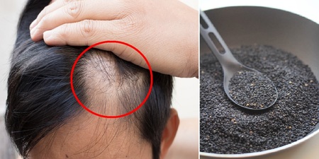 补铁可以防止掉头发吗(掉头发防止补铁可以吃什么)-硒宝网