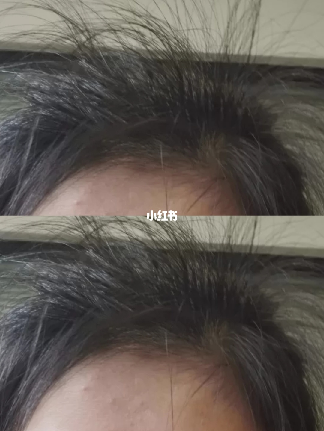 补铁可以防止掉头发吗(掉头发防止补铁可以吃什么)-硒宝网