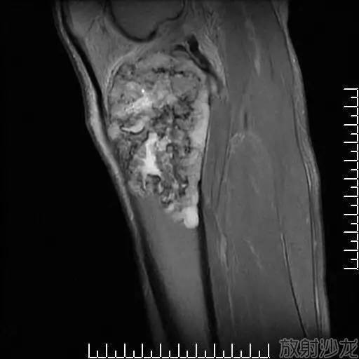 补硒引起骨头疼(缺硒会引起骨质疏松吗)-硒宝网