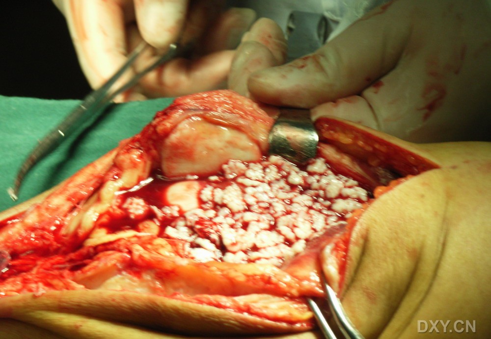 补硒引起骨头疼(缺硒会引起骨质疏松吗)-硒宝网