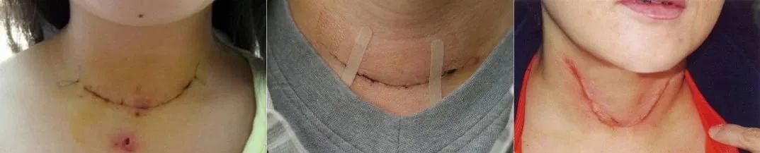 甲状腺全切补硒(甲状腺吃补硒的药)-硒宝网