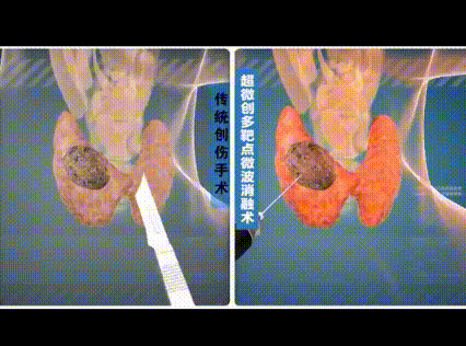 甲状腺全切补硒(甲状腺吃补硒的药)-硒宝网